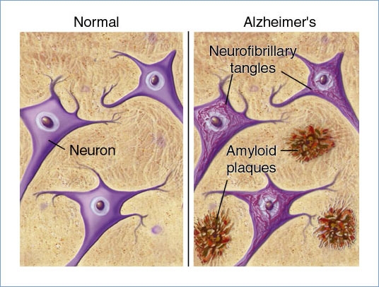 imagini boala alzheimer